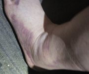 bruised-foot2.jpg bruised-foot2.jpg